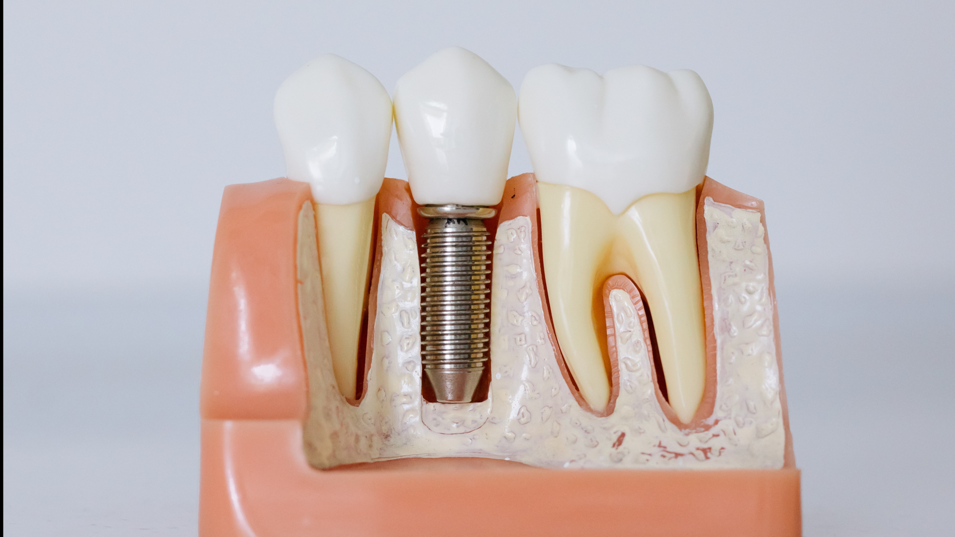 Dental Implant Treatment