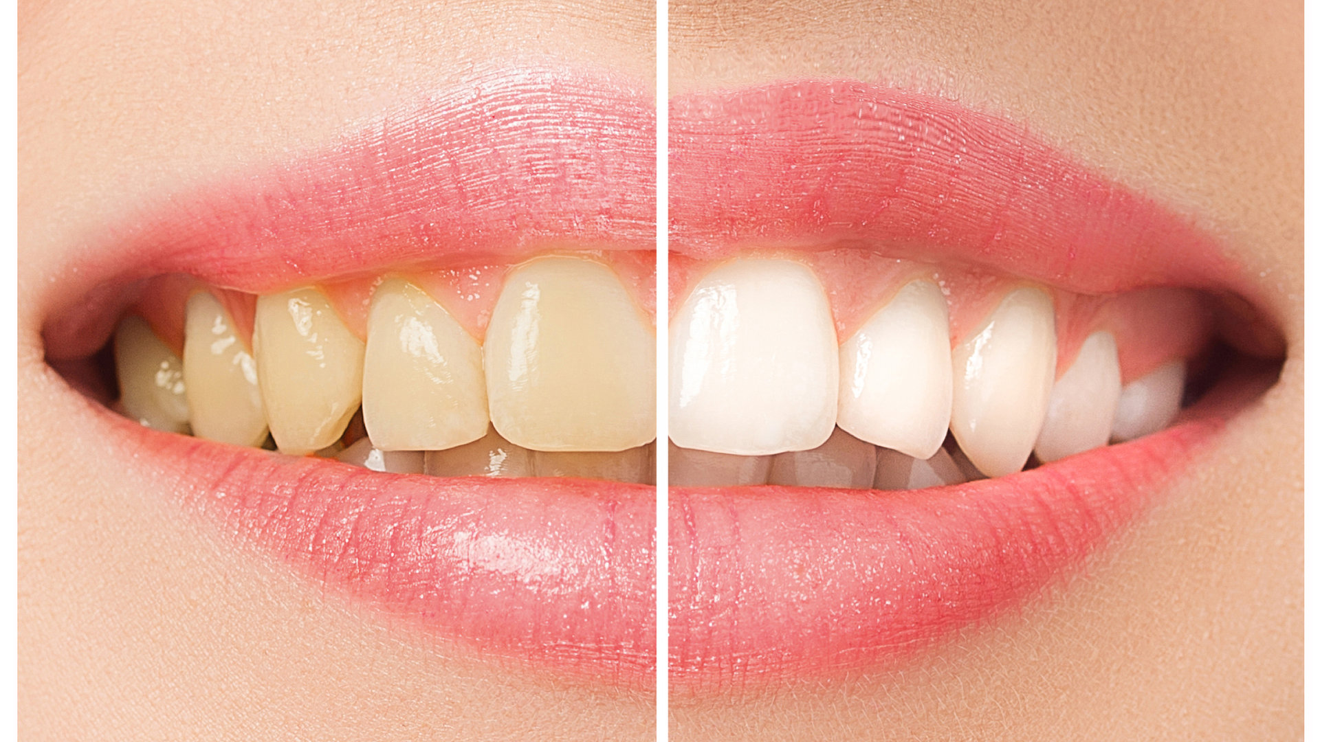 Teeth Whitening and Bleaching