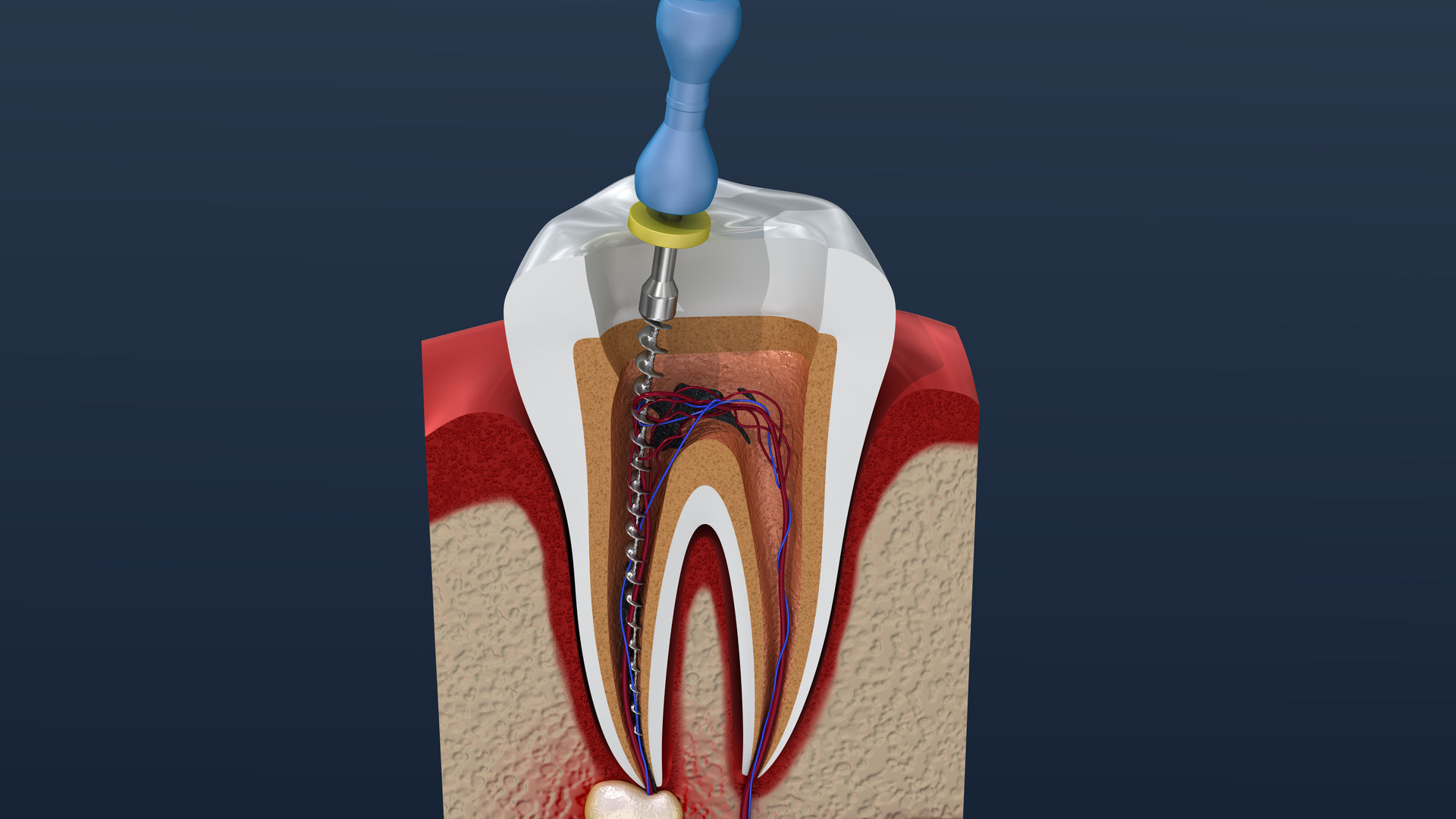 Root canal treatment process. 3D illustration