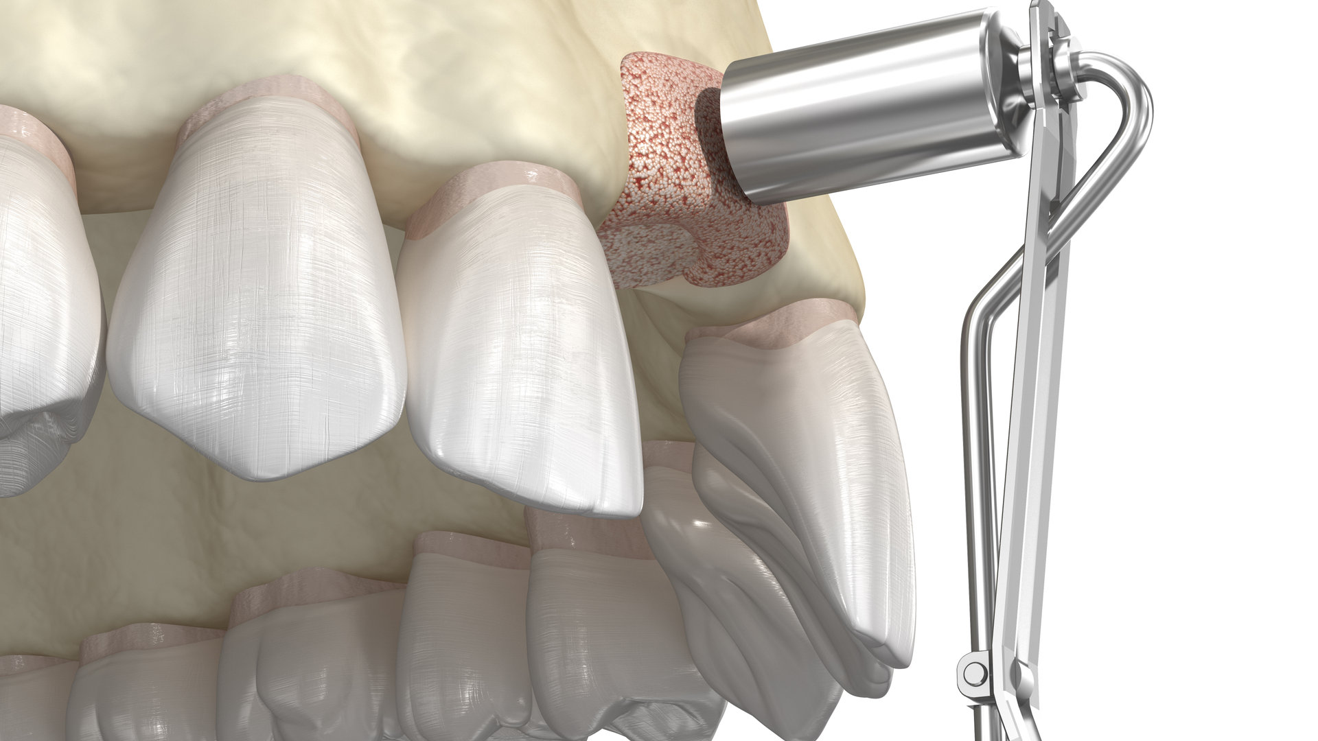 Bone Grafting