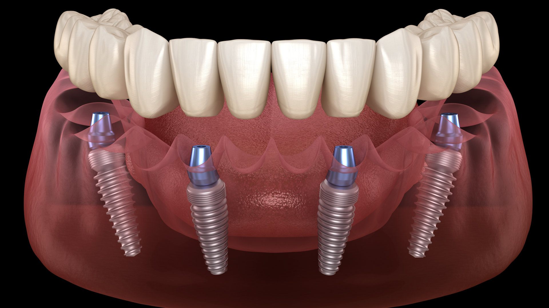 All on 4 Implant Treatment