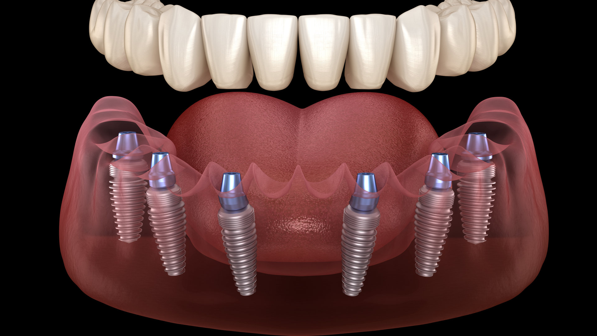 All on 4 Implant Treatment